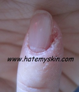 My pinky finger with eczema