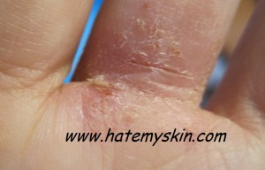 Eczema in between my fingers.